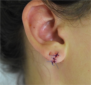 Image related to Split Earlobe Repair Los Angeles