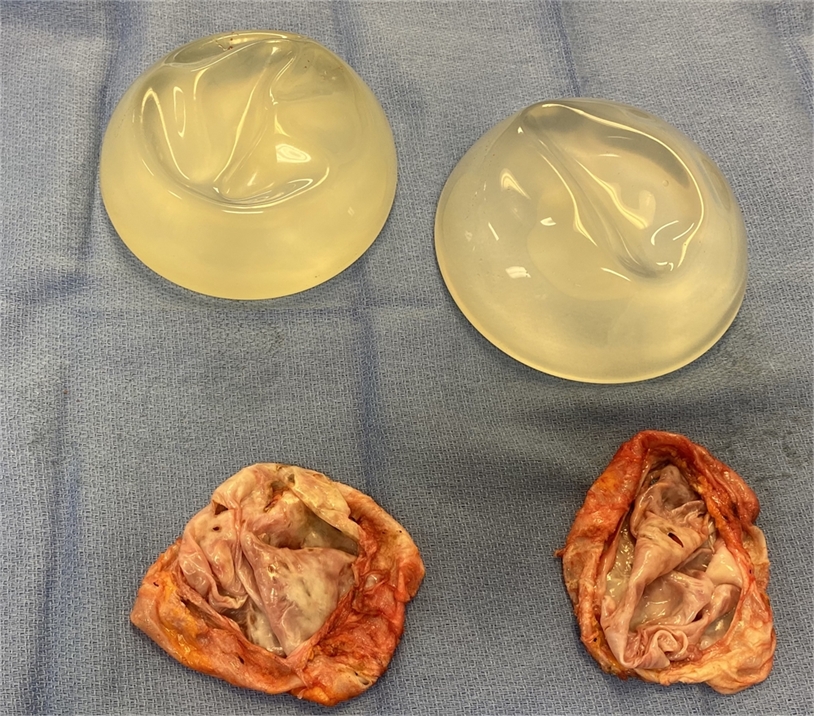 total capsulectomy and breast implant removal