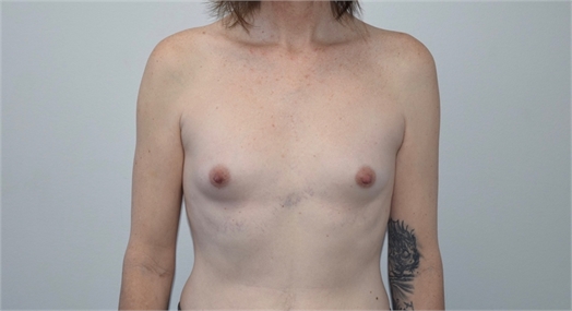 transgender top surgery Before