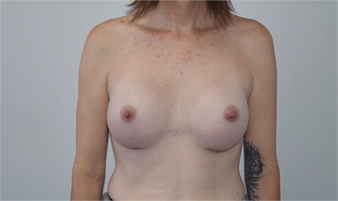 transgender top surgery After