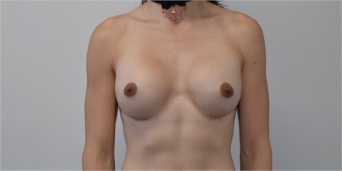 transgender breast augmentation After