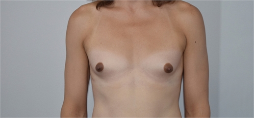 transgender breast augmentation Before
