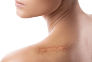 scar revision
