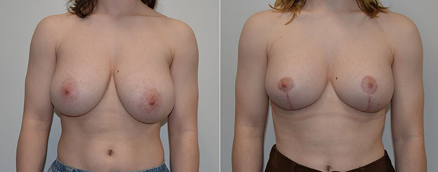 Breast Reduction Surgery Before and After image
