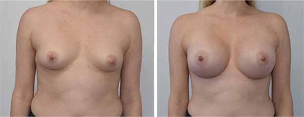 Breast Augmentation Surgery Before and After