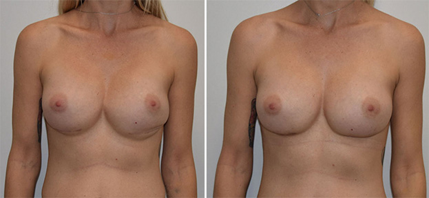 Breast implant revision before and after