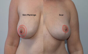Donut Breast Reduction
