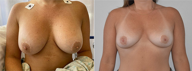 Breast Implant Removal Before and After image