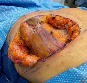 Mesh Breast Reduction