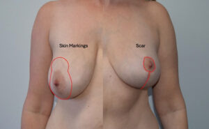 Vertical Breast Reduction